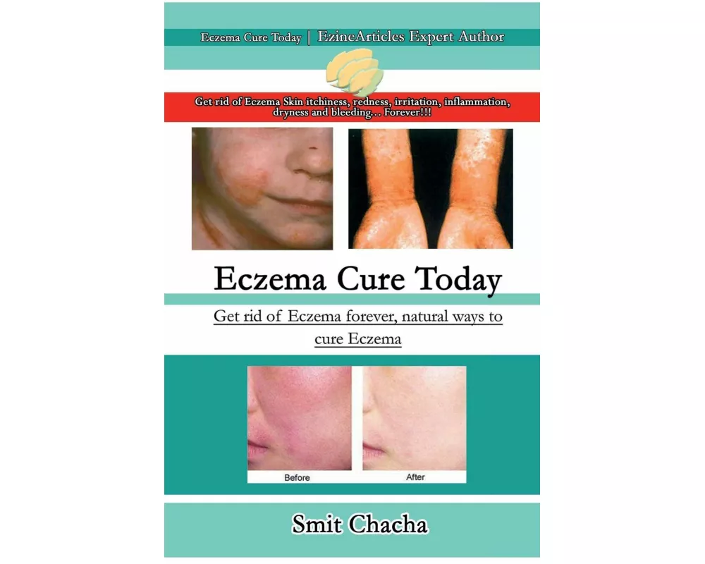 Eczema Cure Today - Get rid of Eczema forever natural ways to cure Eczema