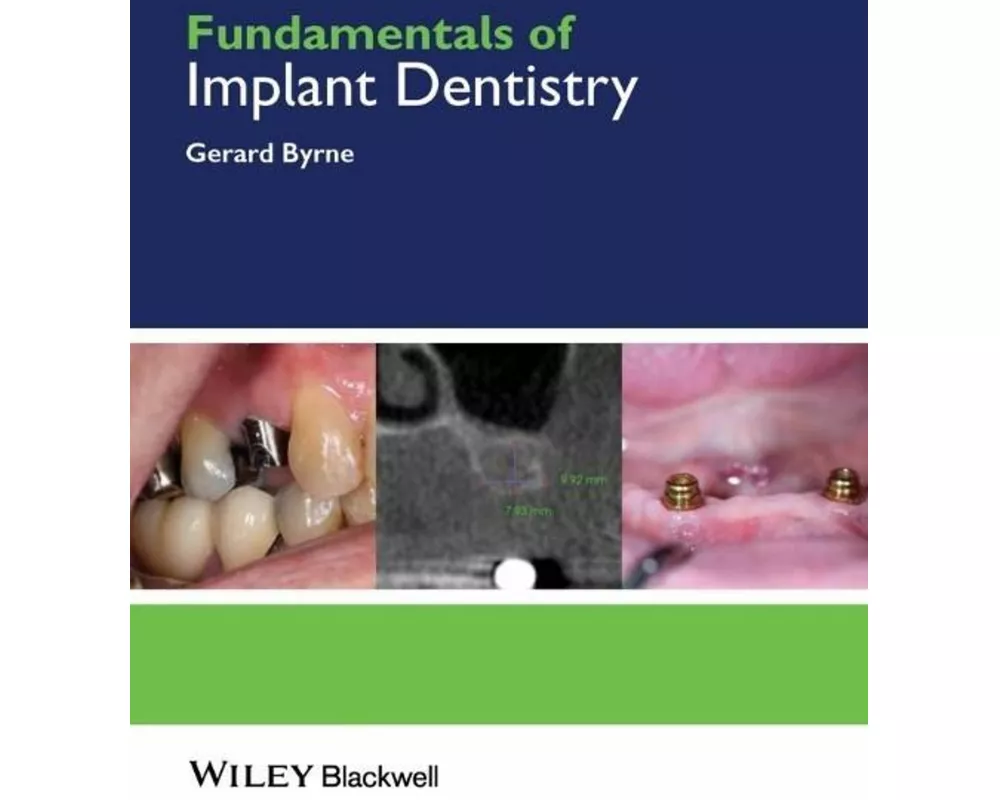 Fundamentals of Implant Dentistry