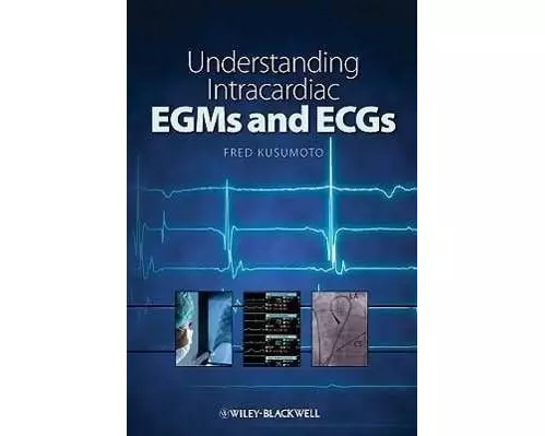 Understanding Intracardiac EGMs and ECGs