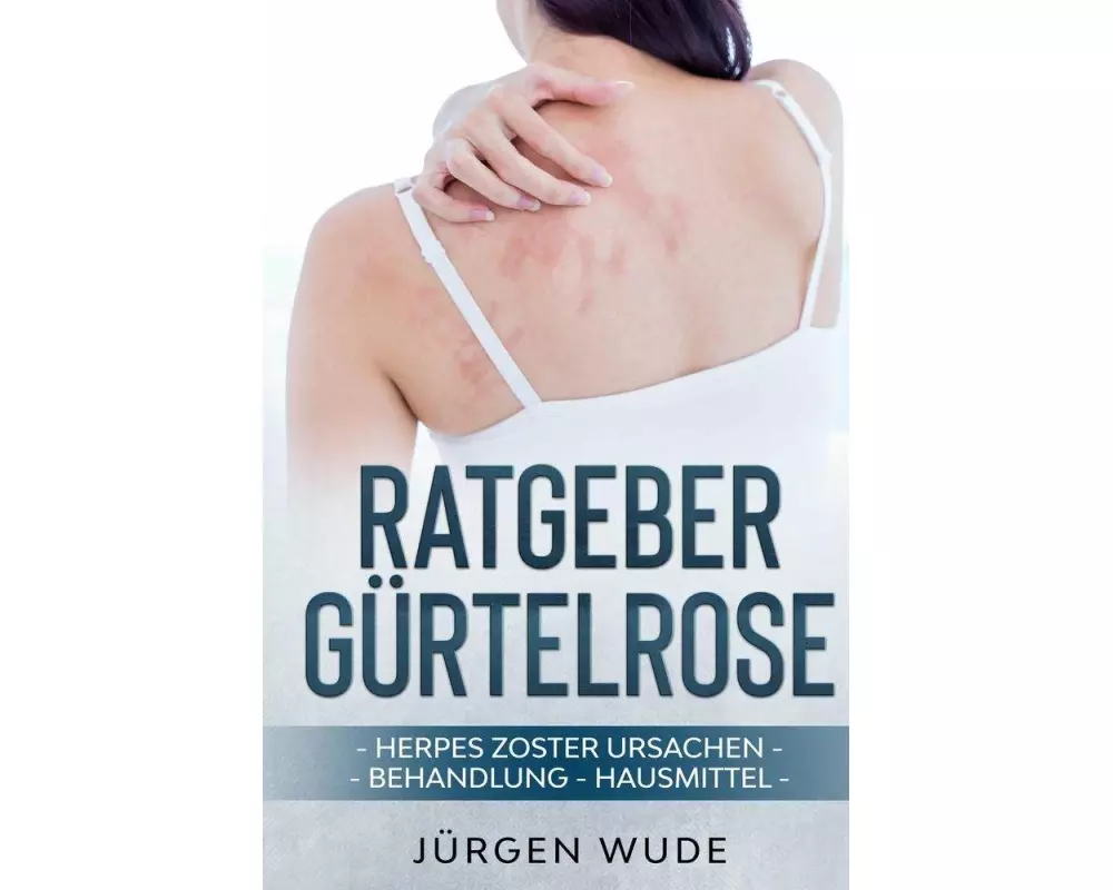 Ratgeber Gürtelrose