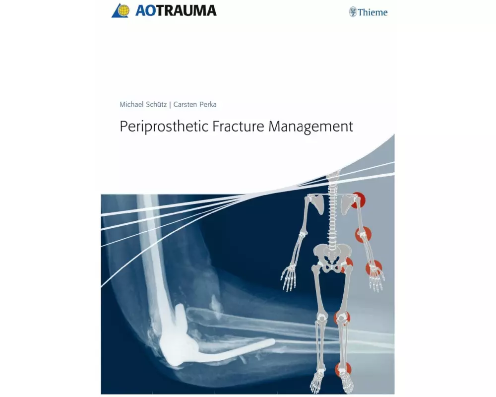 Periprosthetic Fracture Management