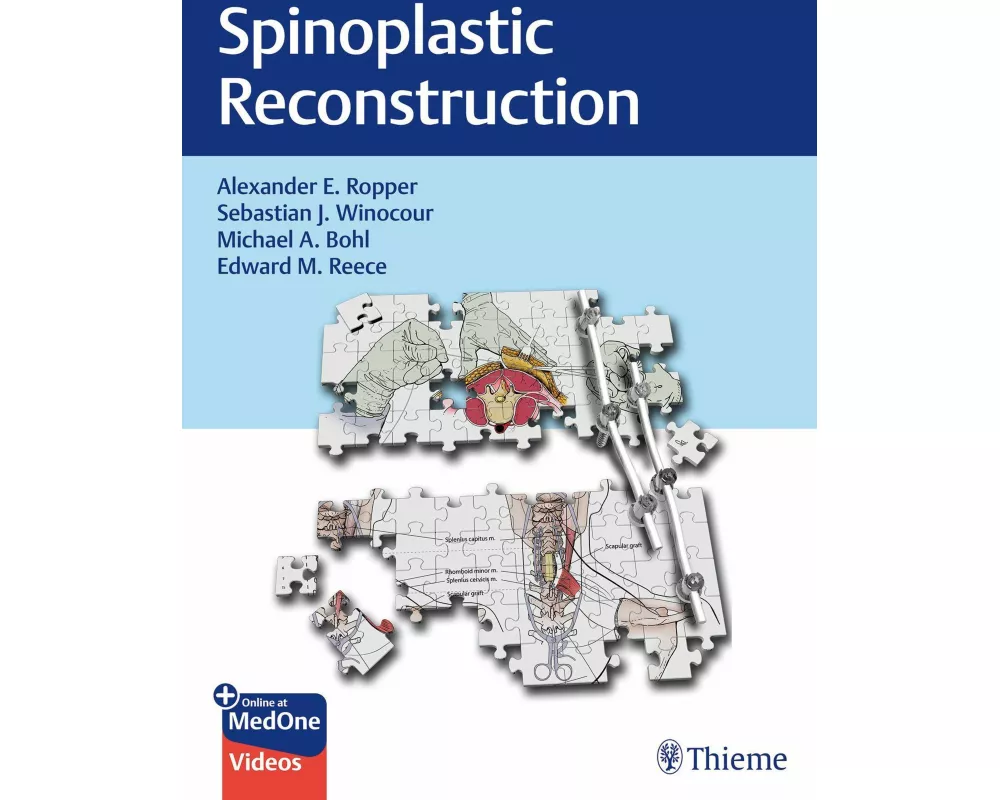 Spinoplastic Reconstruction