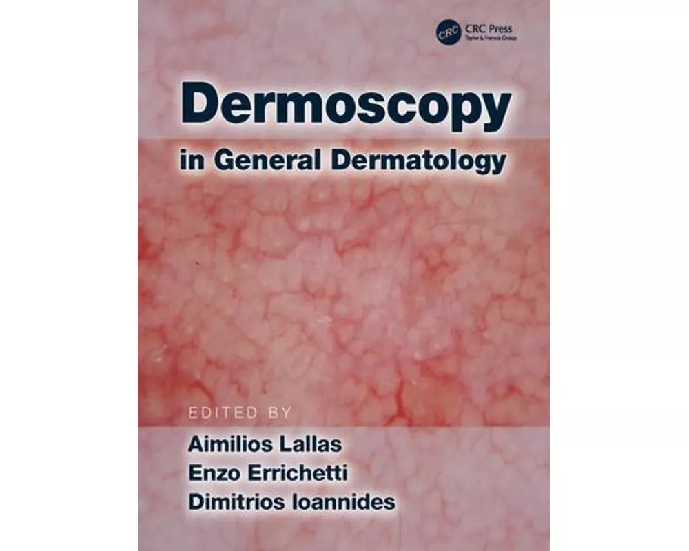 Dermoscopy in General Dermatology