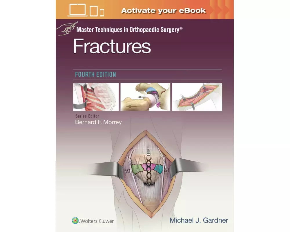 Master Techniques in Orthopaedic Surgery: Fractures