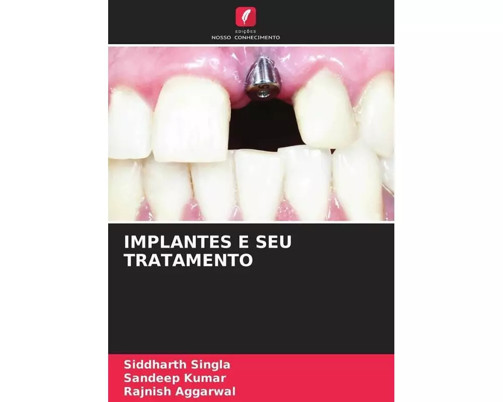 Implantes E Seu Tratamento