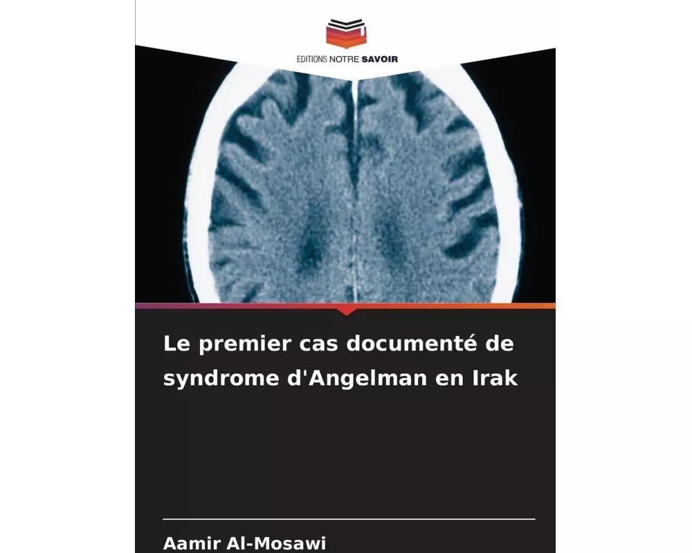 Le premier cas documenté de syndrome d'Angelman en Irak