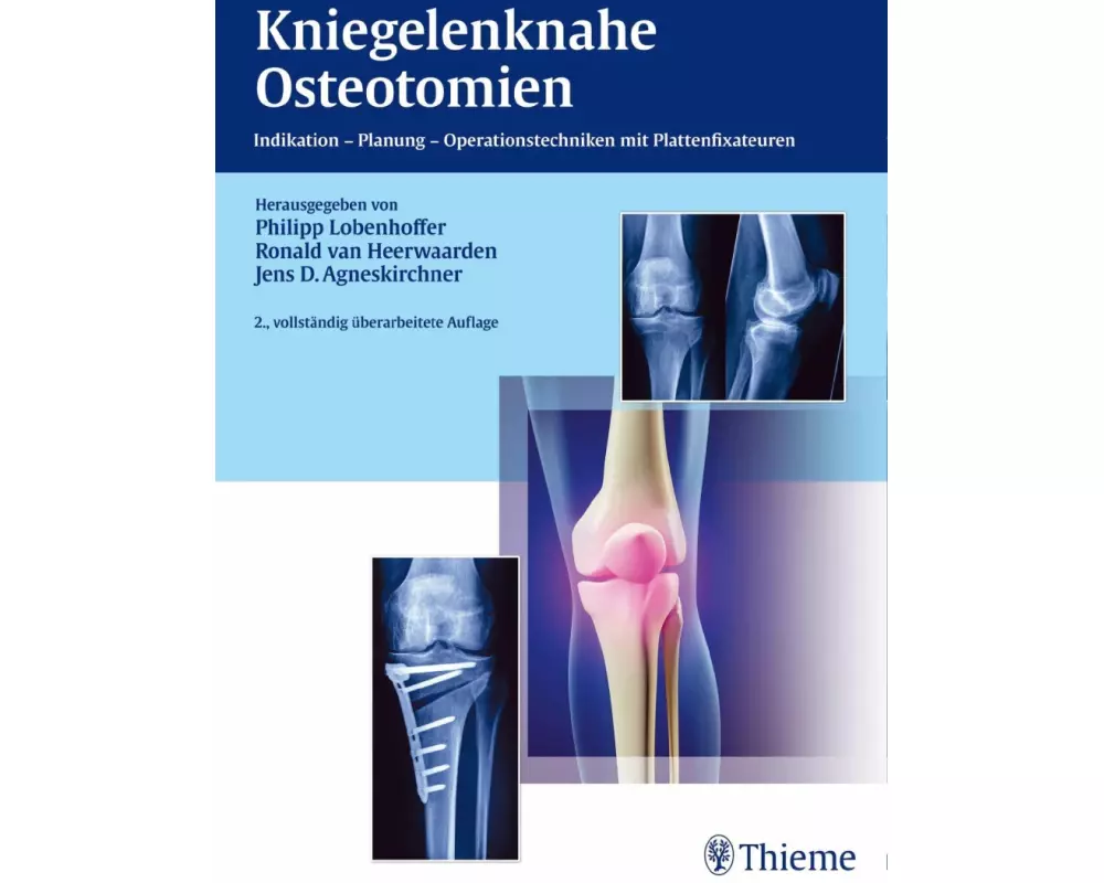 Kniegelenknahe Osteotomien