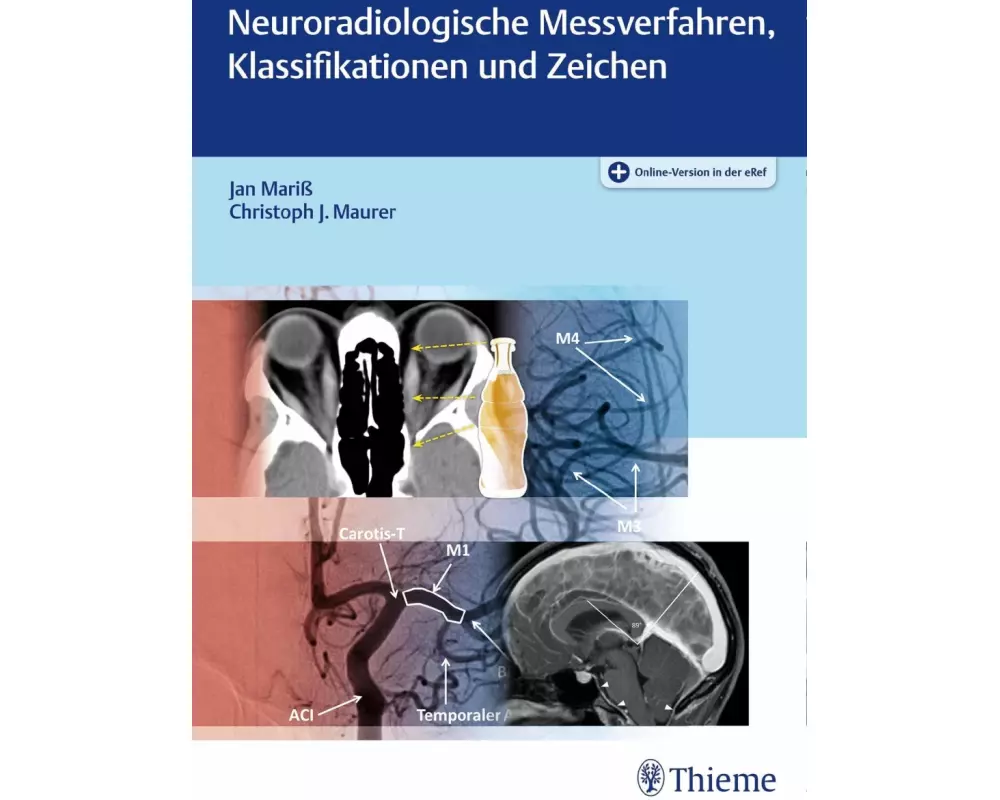 Neuroradiologische Messverfahren, Klassifikationen und Zeichen