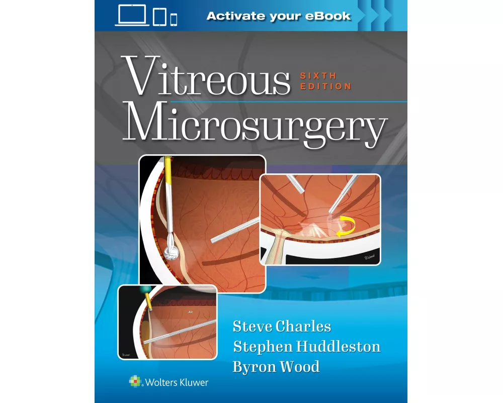 Vitreous Microsurgery