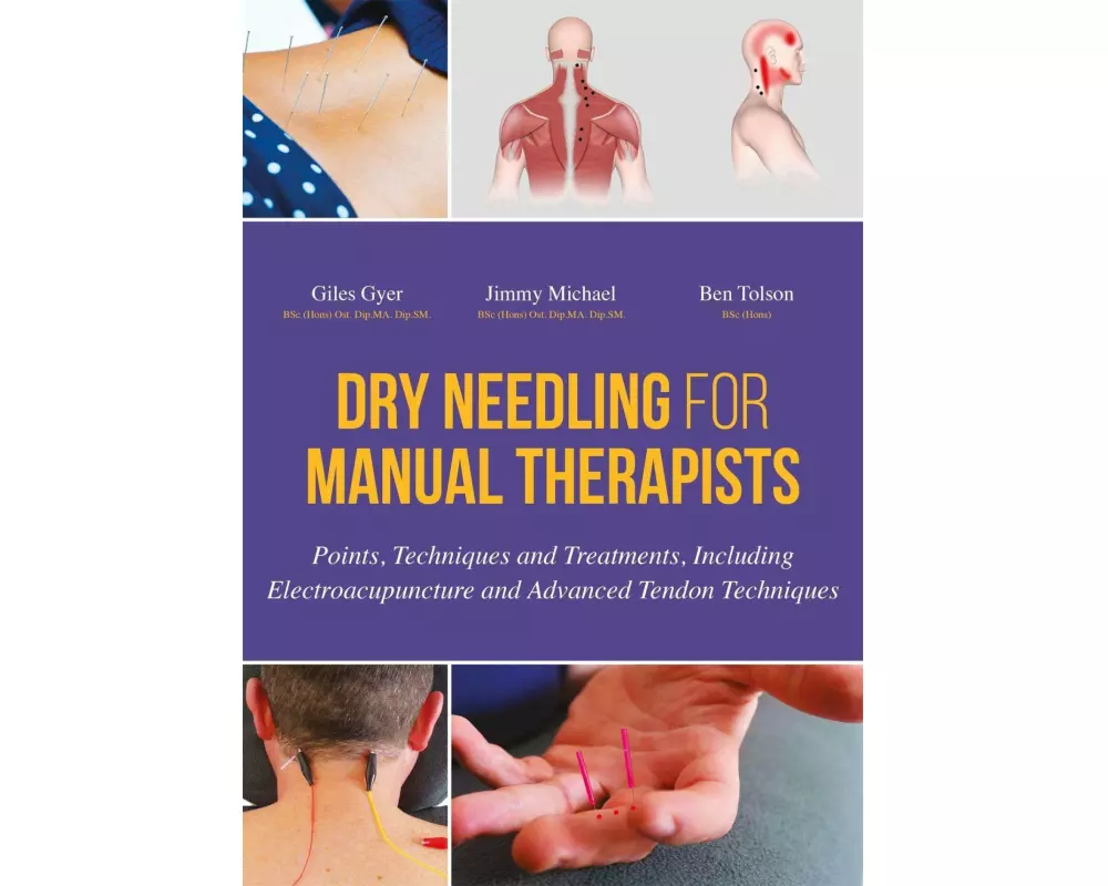 Dry Needling for Manual Therapists
