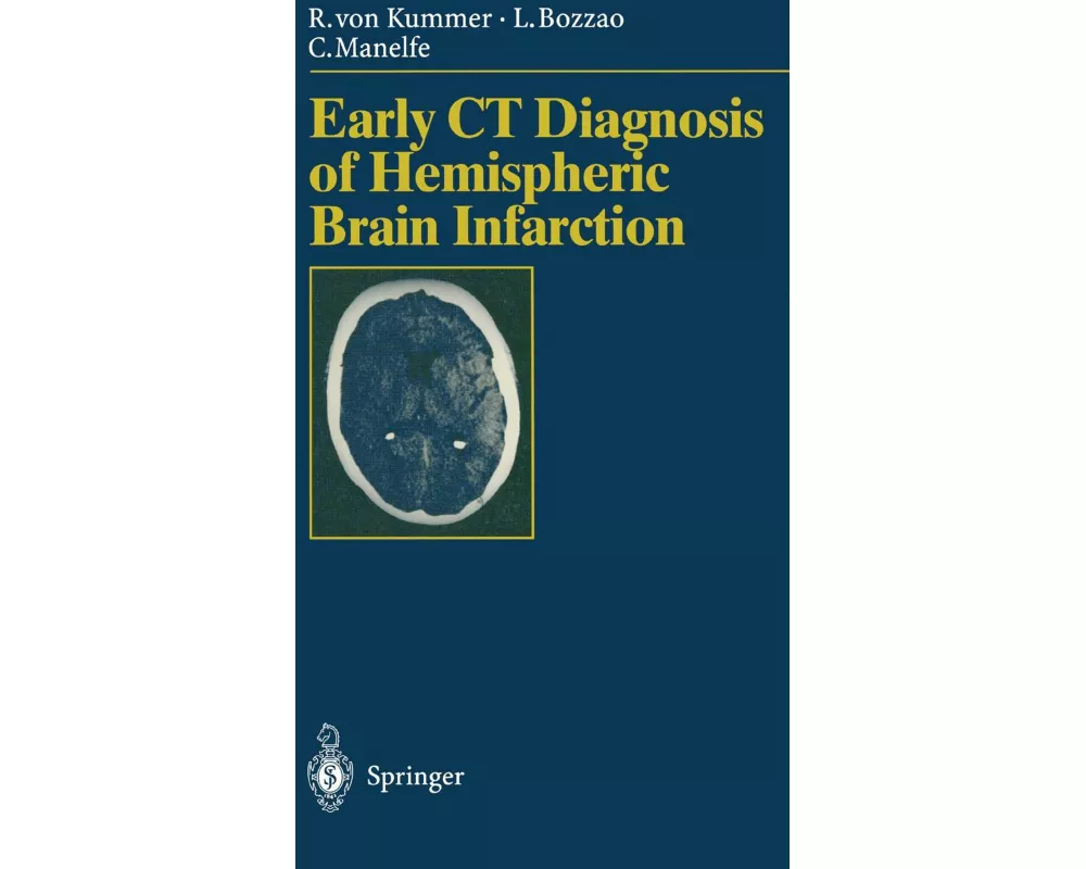 Early CT Diagnosis of Hemispheric Brain Infarction
