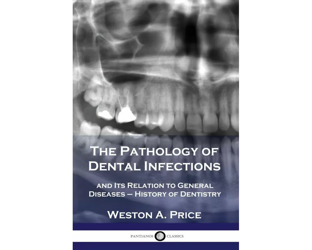 The Pathology of Dental Infections