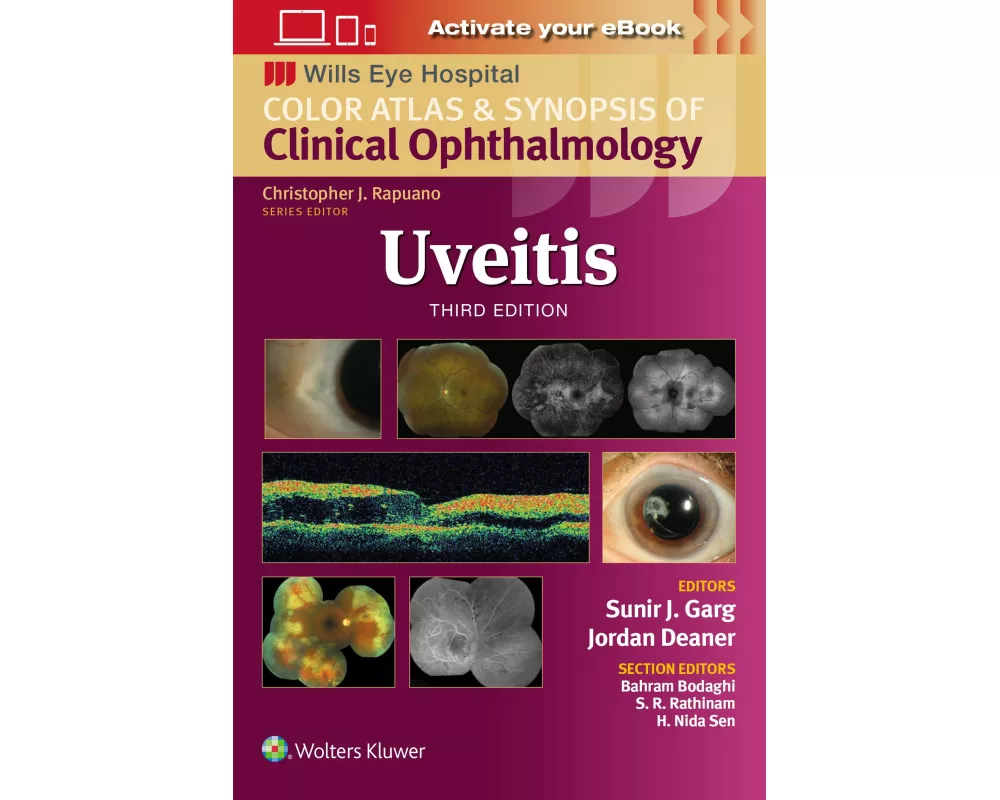 Uveitis