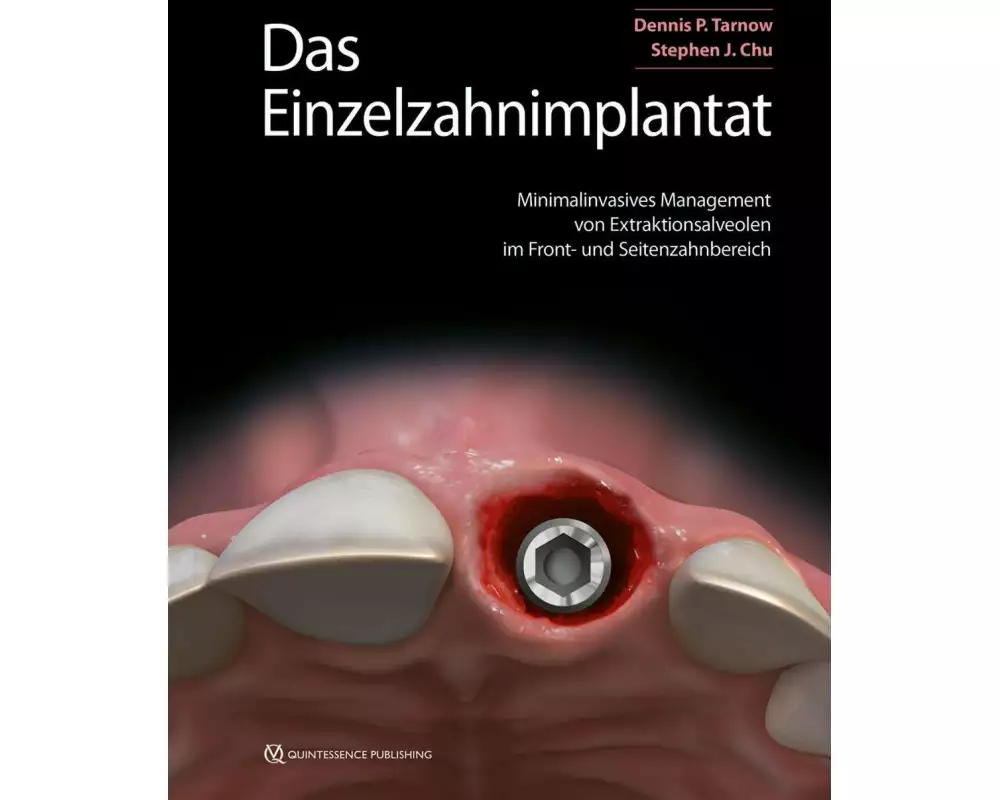 Das Einzelzahnimplantat