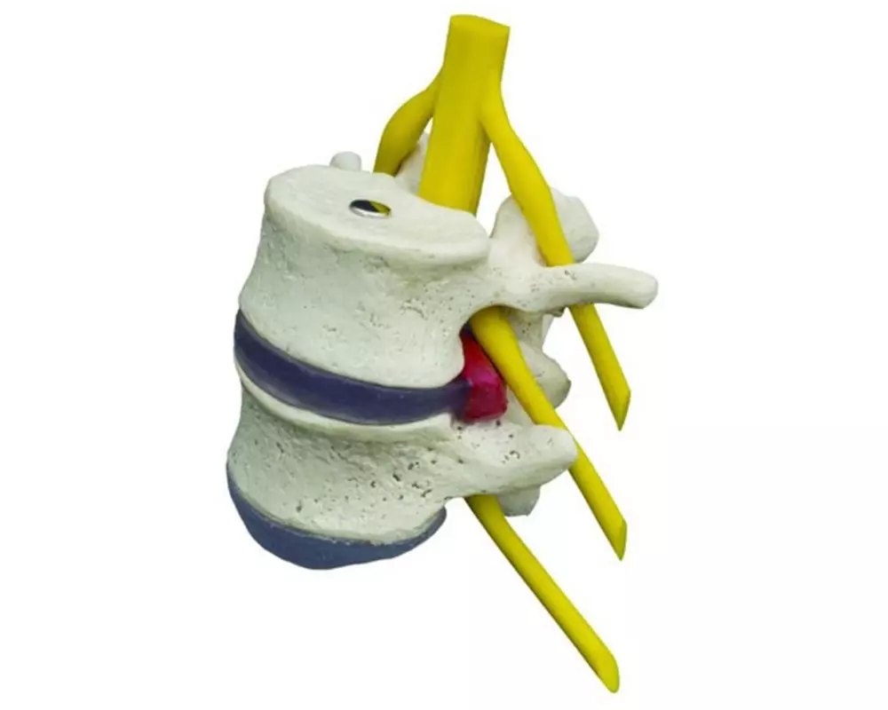 Rüdiger Modell Bandscheibenvorfall