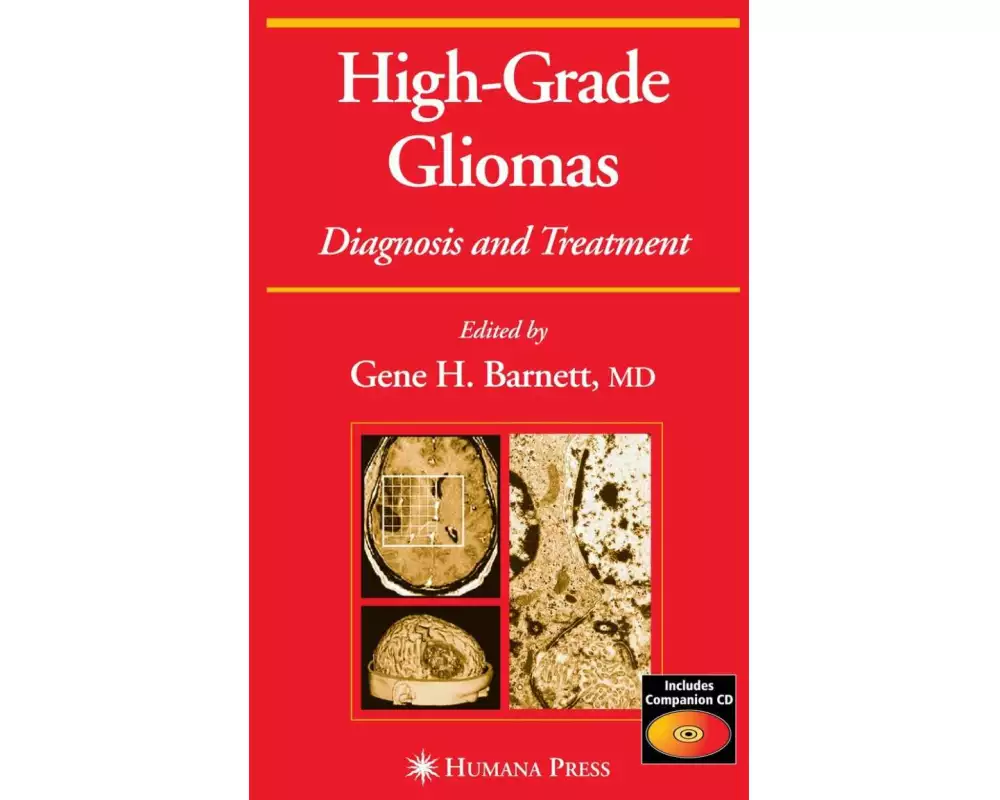 High-Grade Gliomas