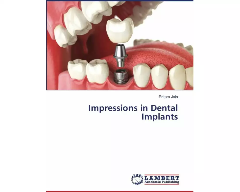 Impressions in Dental Implants