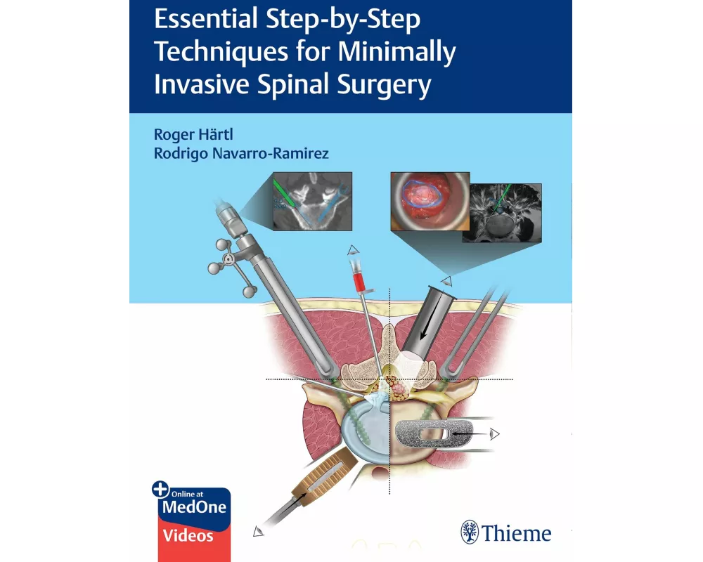 Essential Step-by-Step Techniques for Minimally Invasive Spinal Surgery