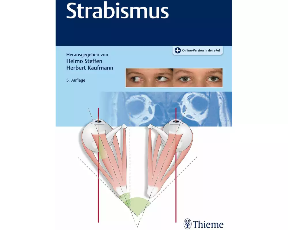 Strabismus