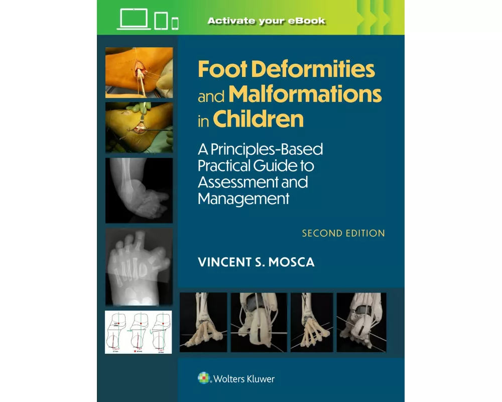 Foot Deformities and Malformations in Children