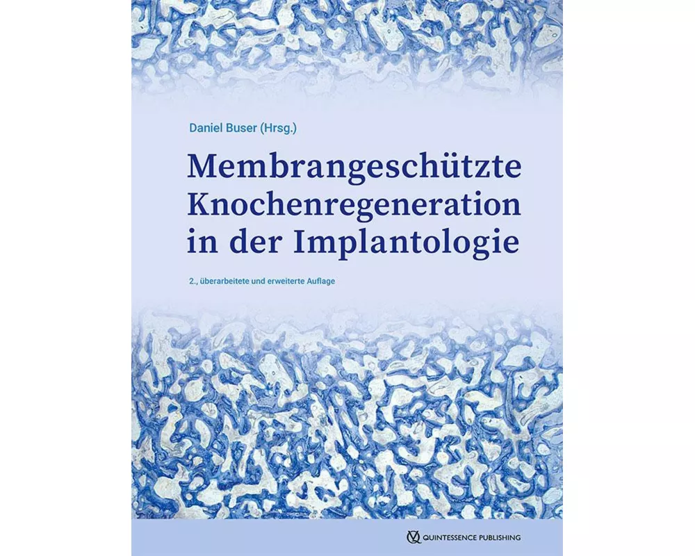 GBR-Technik in der Implantologie