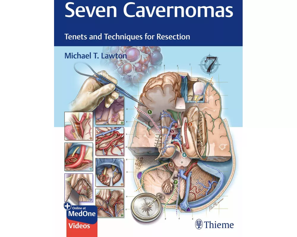 Seven Cavernomas