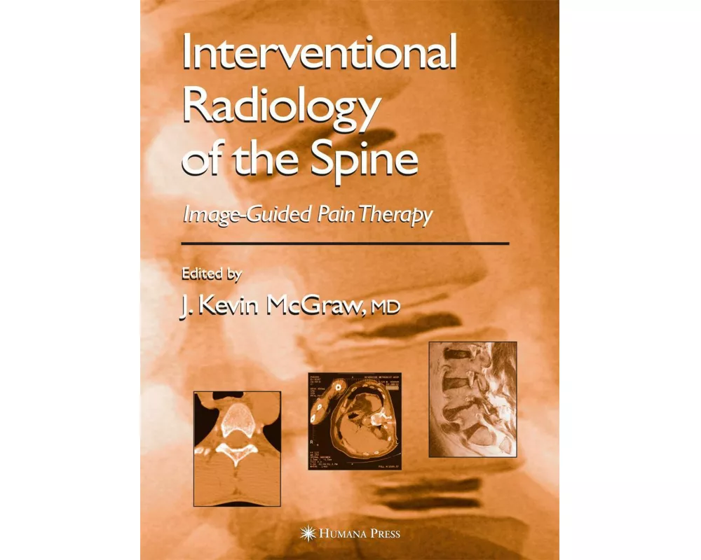 Interventional Radiology of the Spine