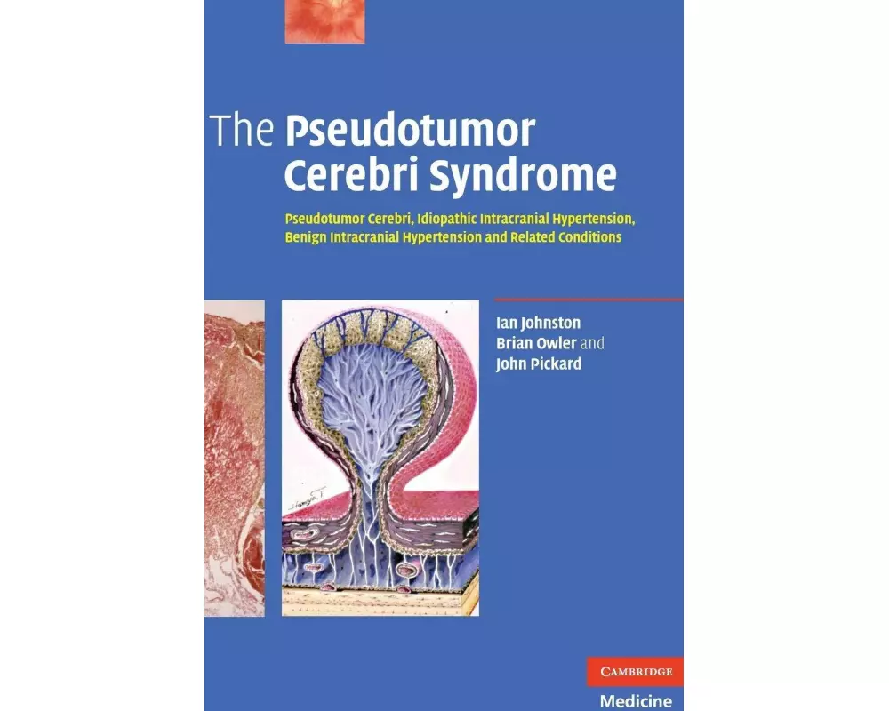 The Pseudotumor Cerebri Syndrome