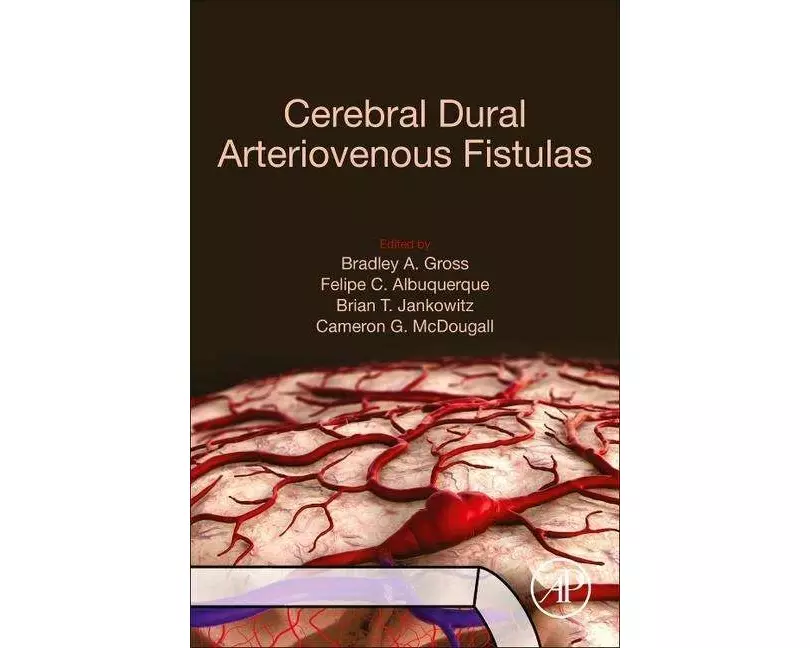 Cerebral Dural Arteriovenous Fistulas