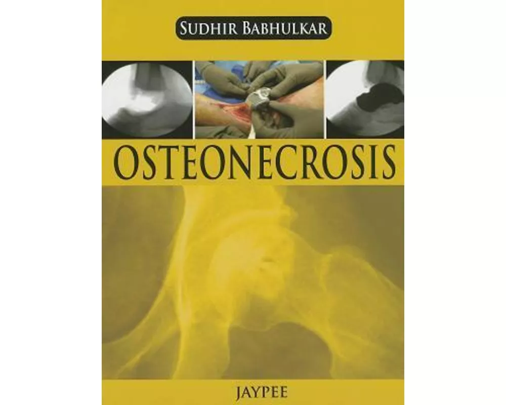 Osteonecrosis