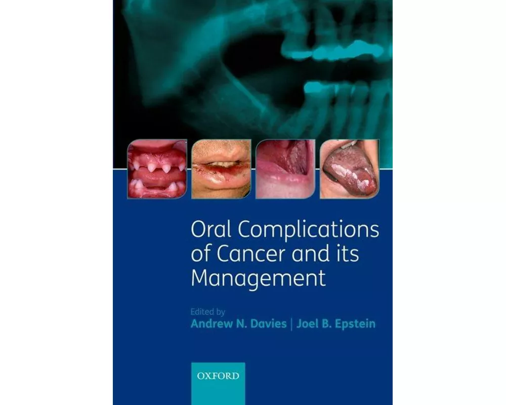 Oral Complications of Cancer and its Management