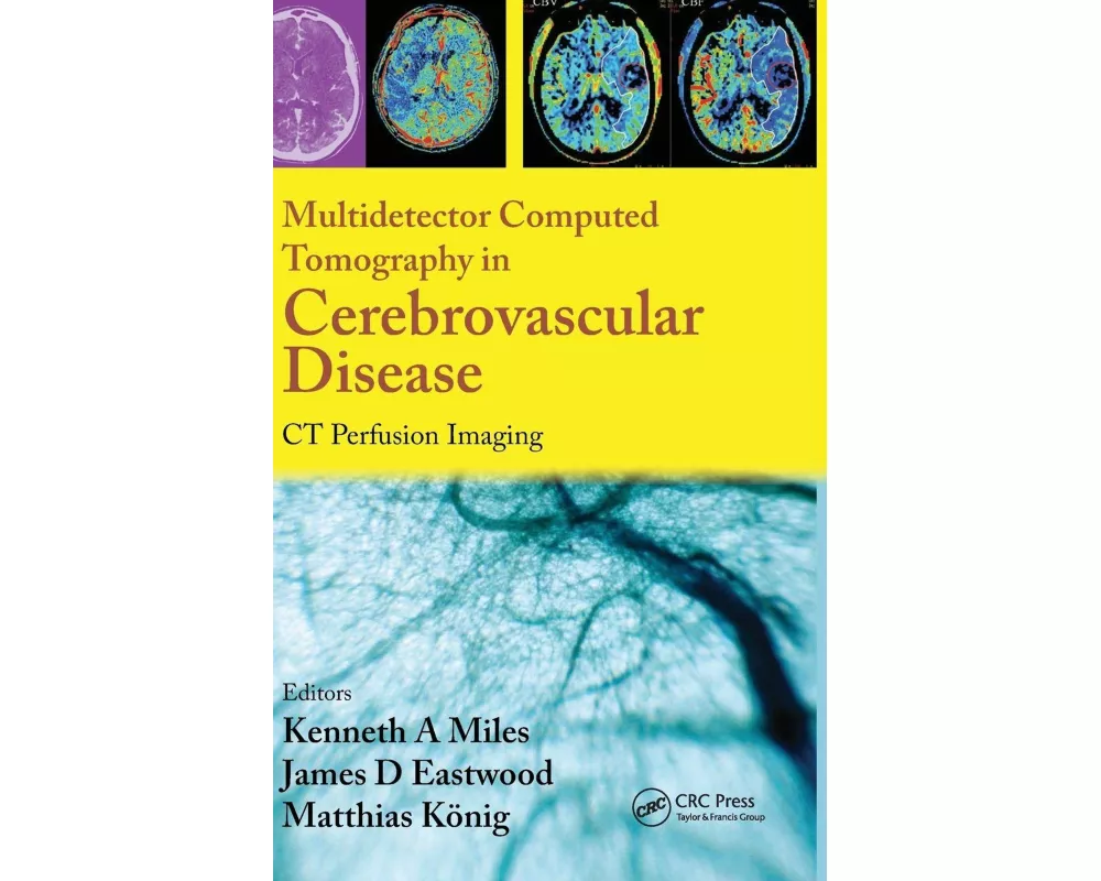 Multidetector Computed Tomography in Cerebrovascular Disease