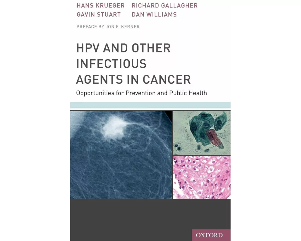 HPV and Other Infectious Agents in Cancer