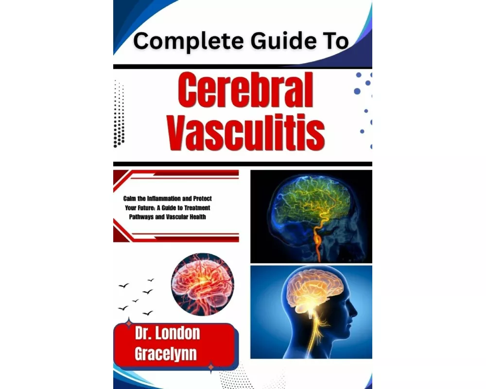 Complete Guide To Cerebral Vasculitis