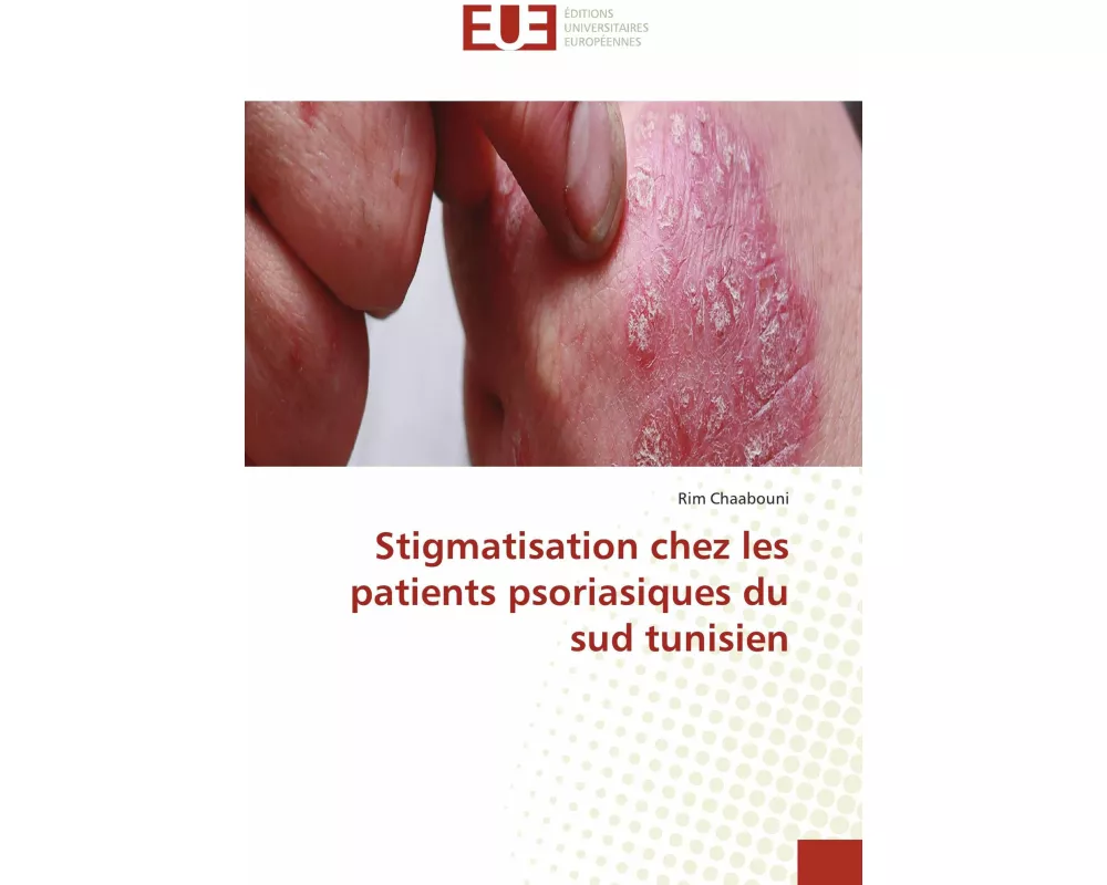 Stigmatisation chez les patients psoriasiques du sud tunisien