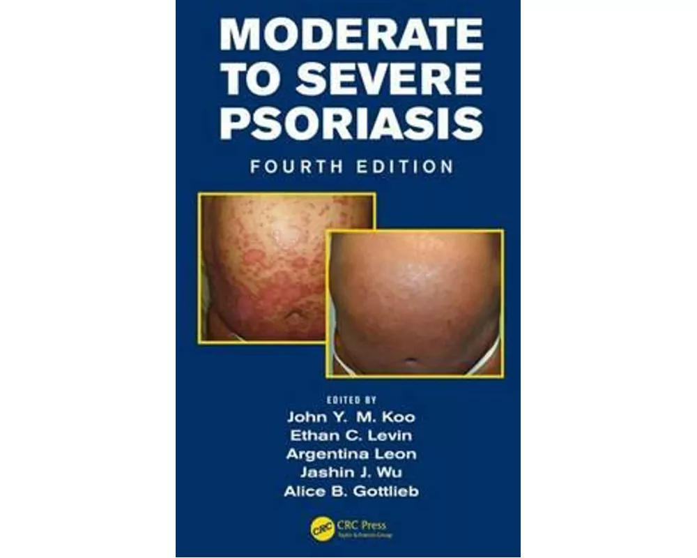 Moderate to Severe Psoriasis