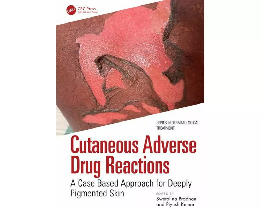 Cutaneous Adverse Drug Reactions