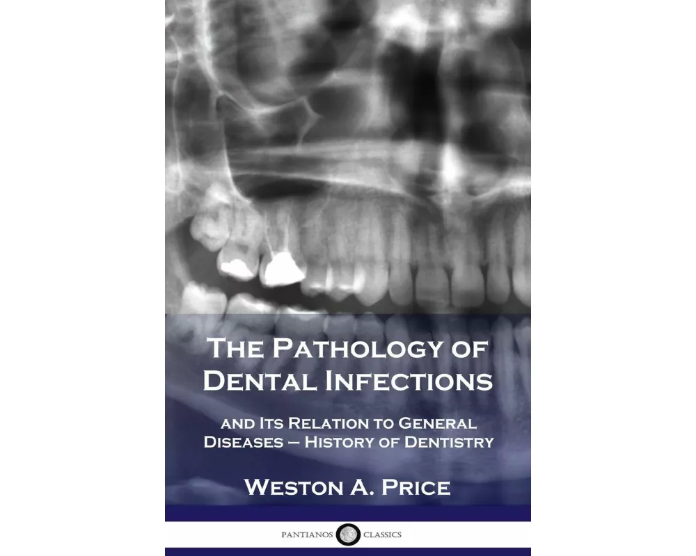 Pathology of Dental Infections