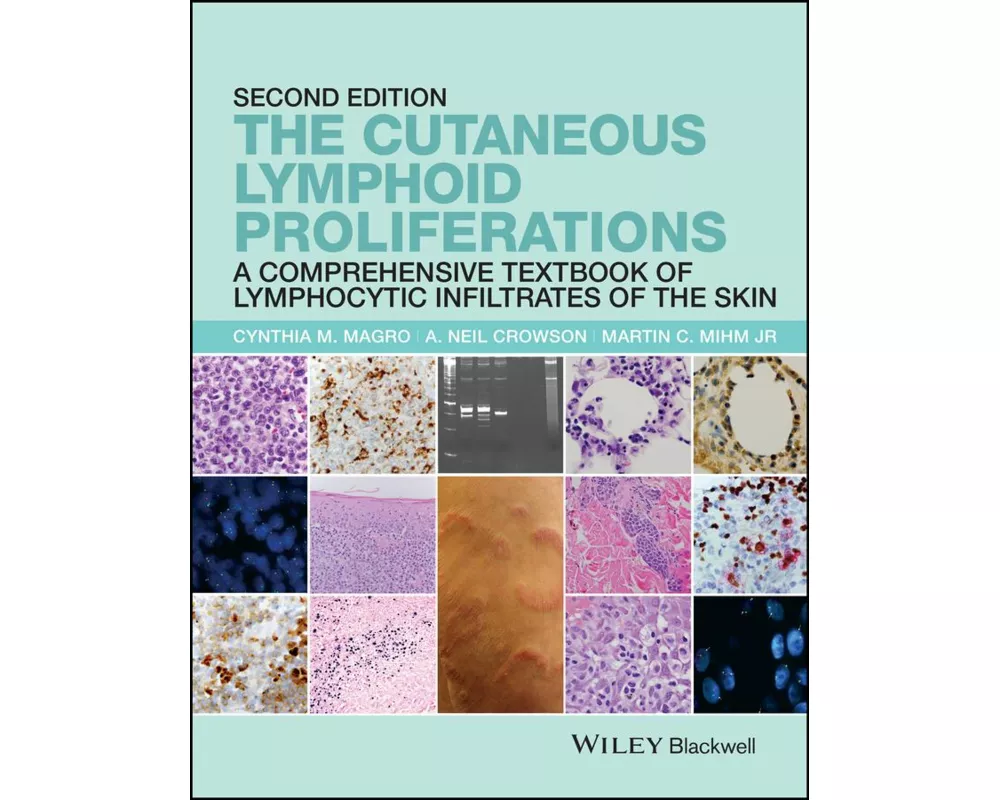 The Cutaneous Lymphoid Proliferations