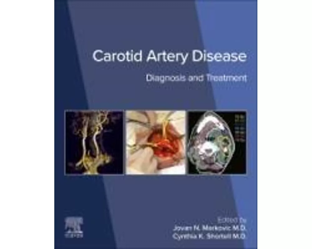 Carotid Artery Disease