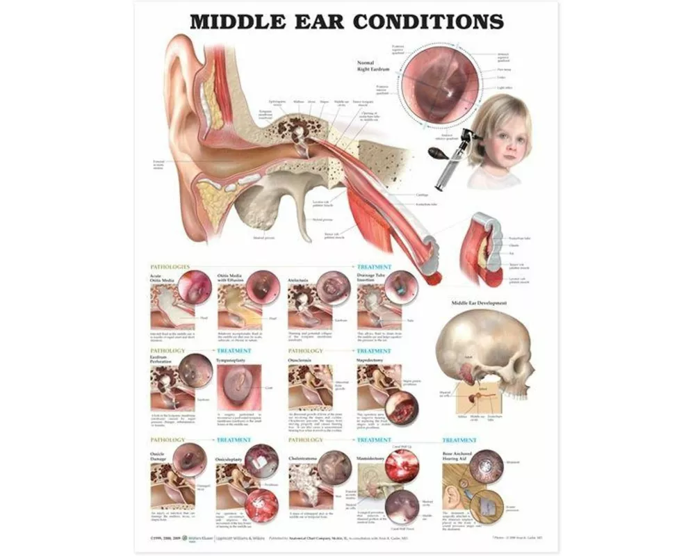 Middle Ear Conditions Anatomical Chart