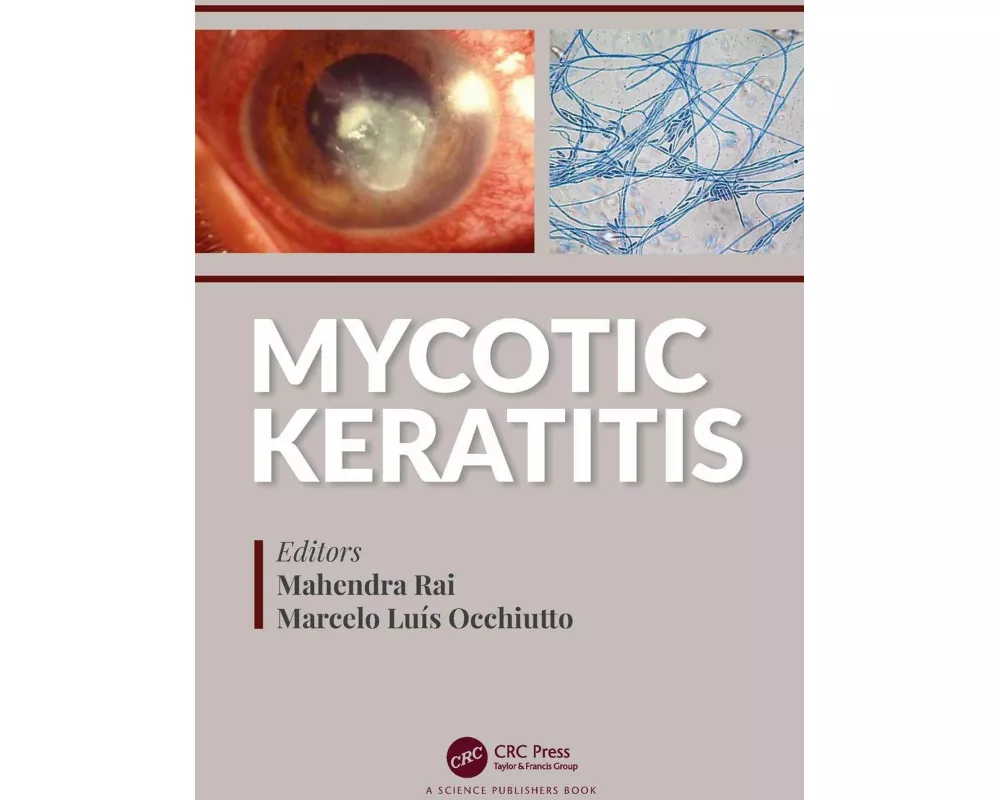 Mycotic Keratitis