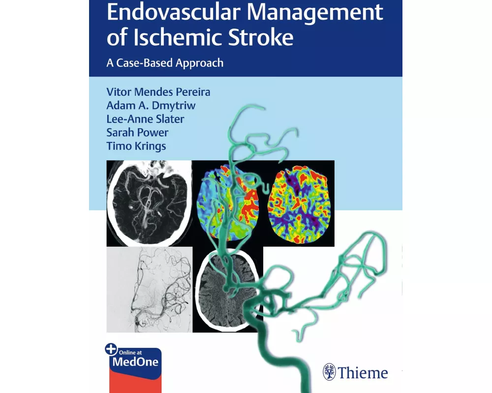 Endovascular Management of Ischemic Stroke