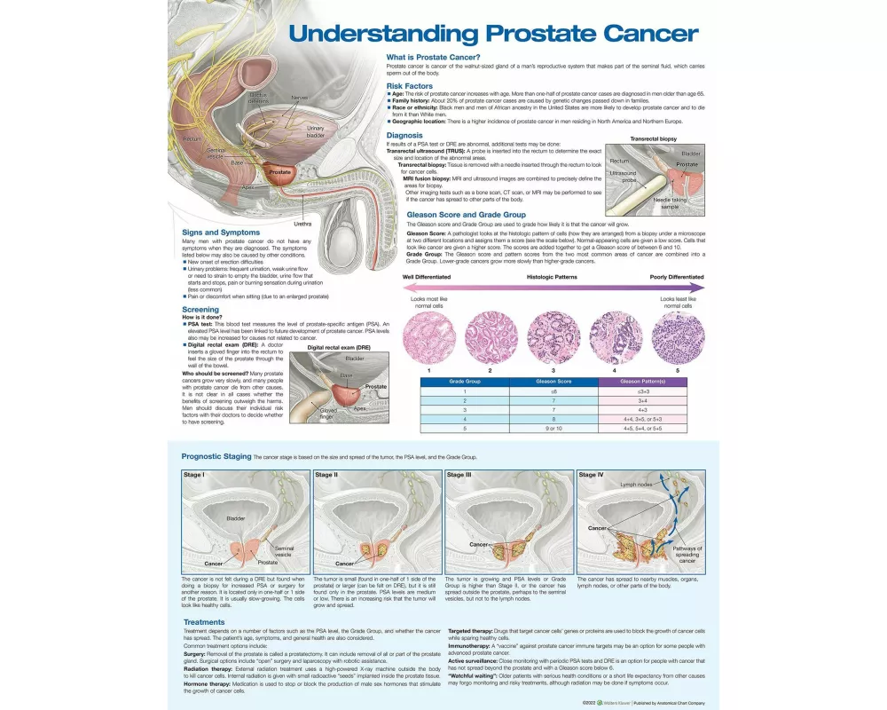 Understanding Prostate Cancer Anatomical Chart