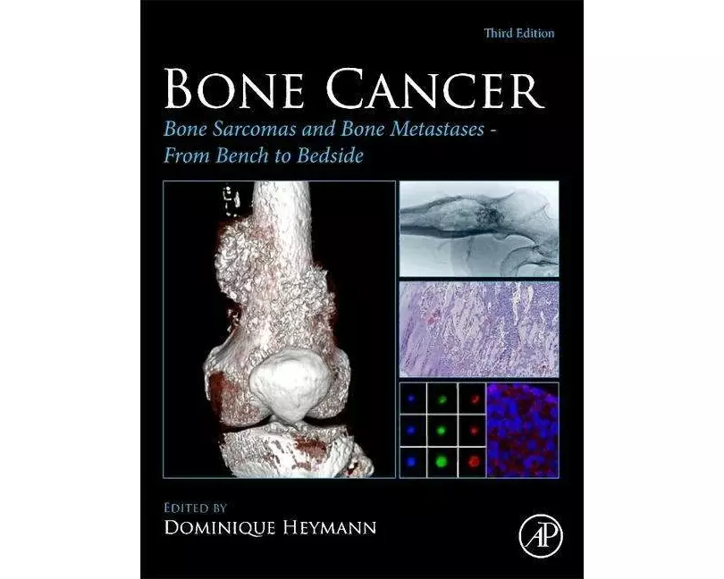 Bone Cancer