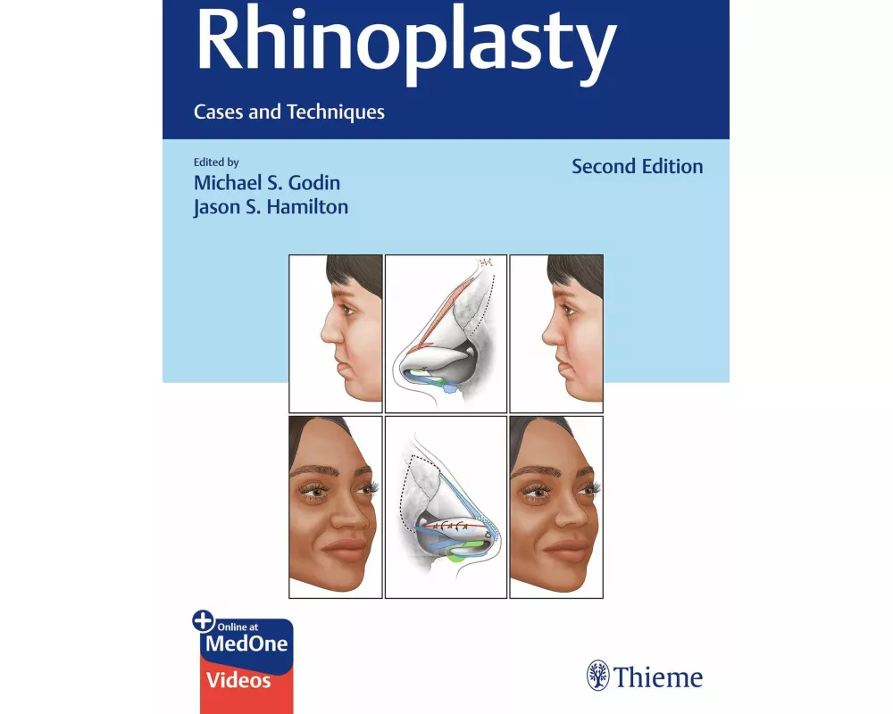 Rhinoplasty
