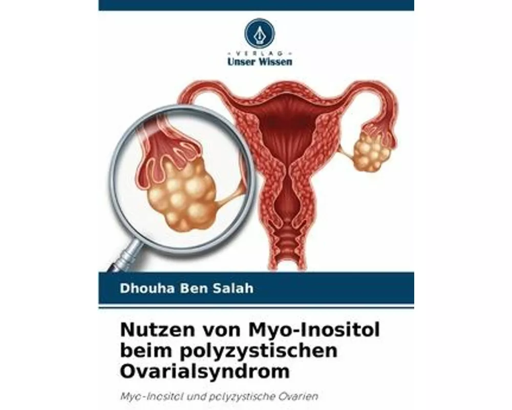 Nutzen von Myo-Inositol beim polyzystischen Ovarialsyndrom