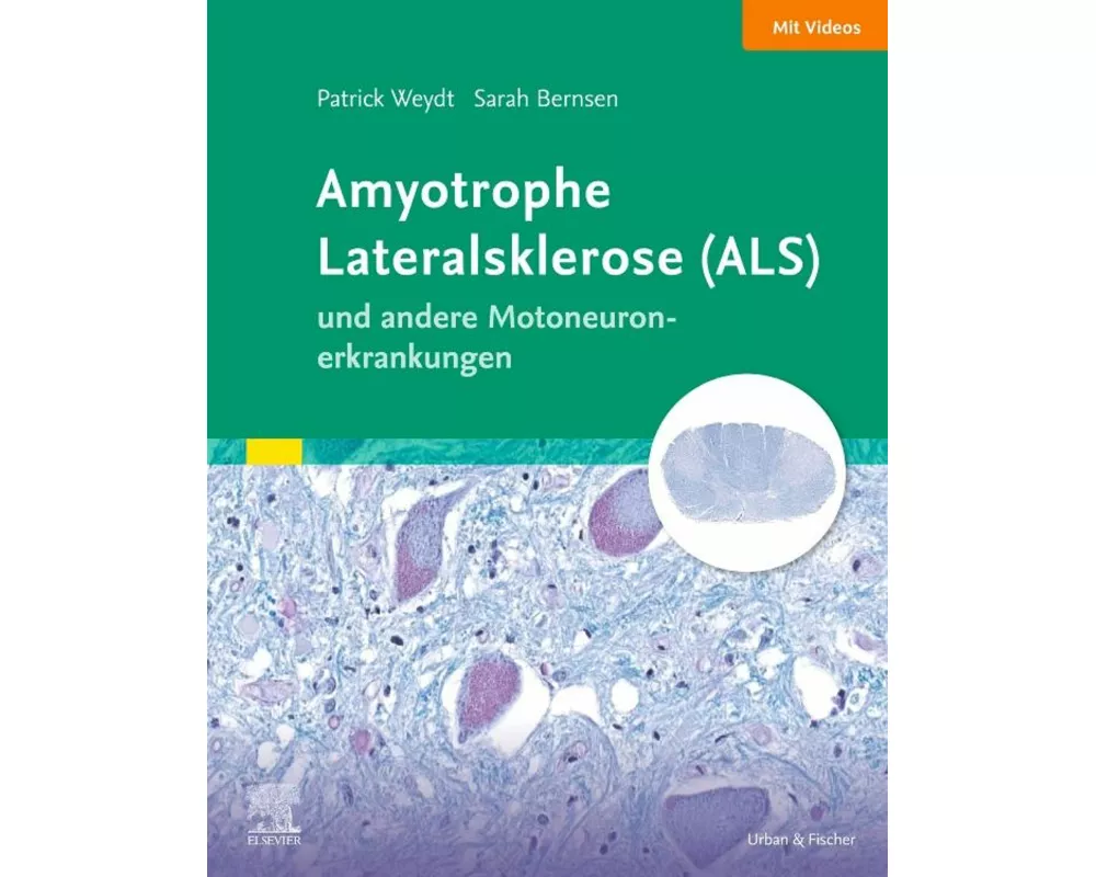 Amyotrophe Lateralsklerose (ALS) und andere Motoneuronerkrankungen