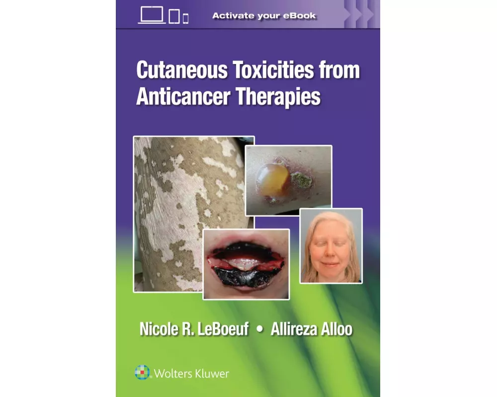 Cutaneous Toxicities from Anticancer Therapies