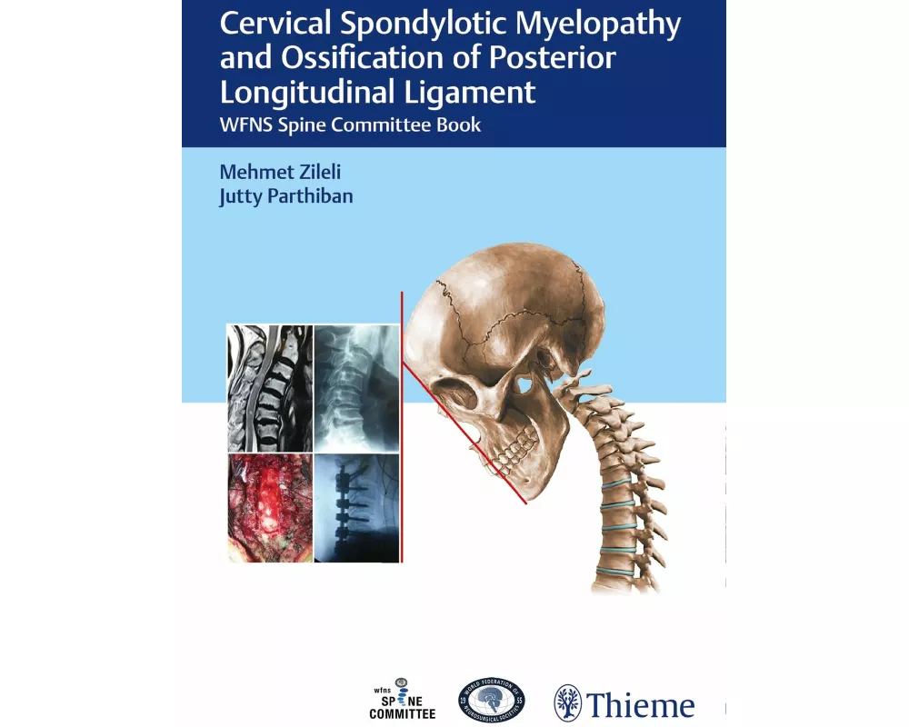 Cervical Spondylotic Myelopathy and Ossification of Posterior Longitudinal Ligament